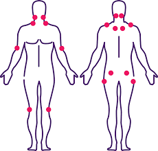 7 sintomas fibromialgia